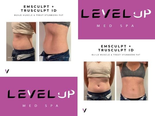 emsculpt neo Andover MA 01810